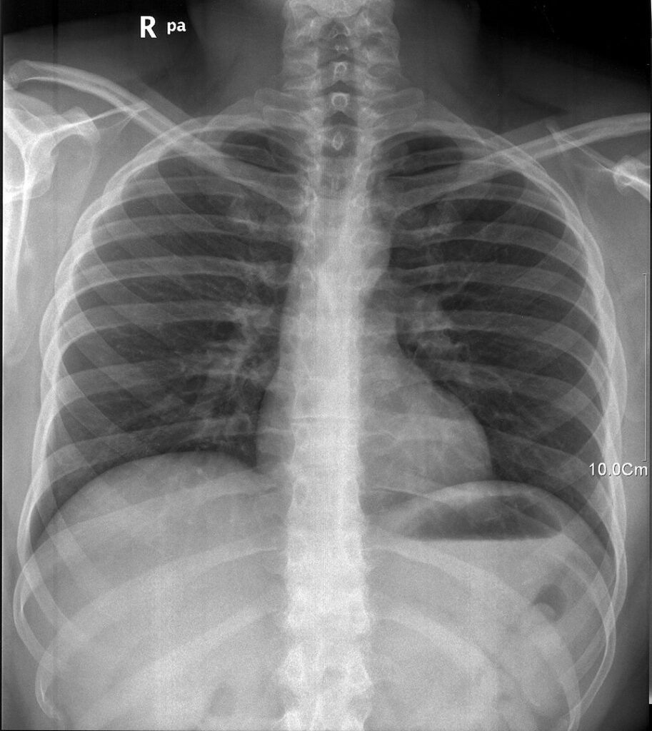 X-Rays Were a Lab Glitch