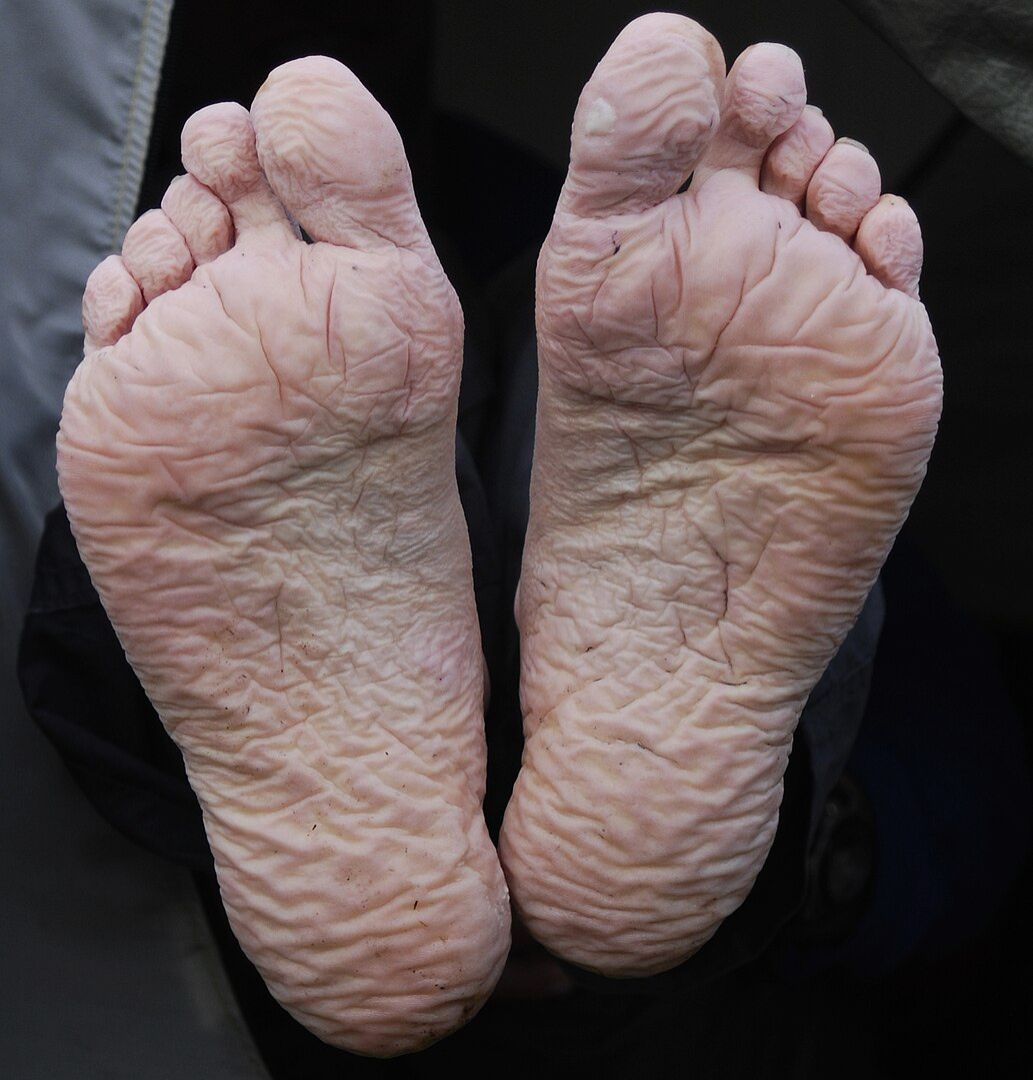 Trench Foot and Duckboards